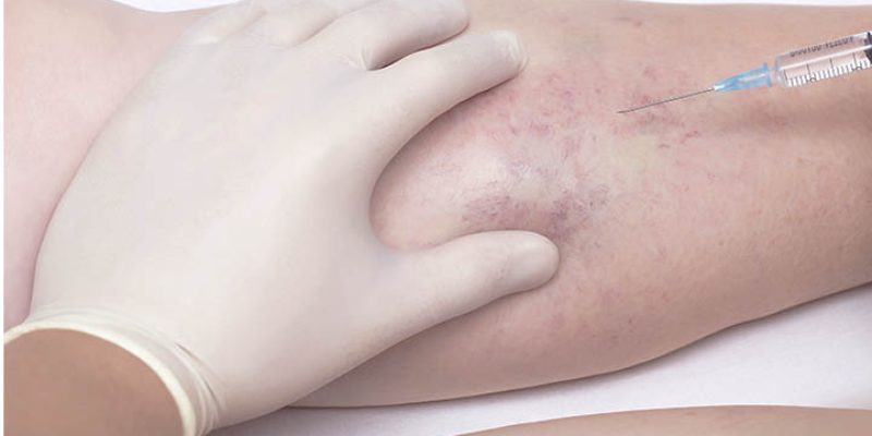 ESCLEROTERAPIA