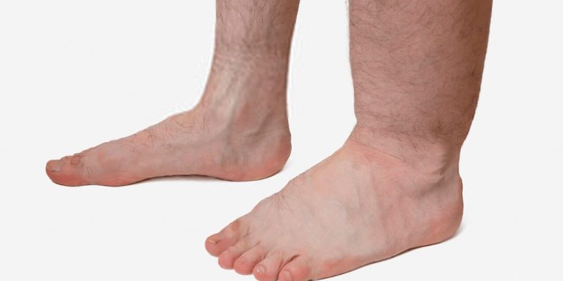 LINFEDEMA-1024x850_Easy-Resize.com