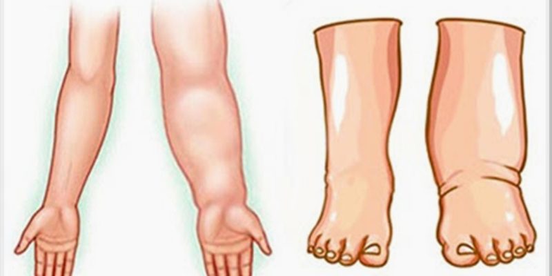 linfedema__Easy-Resize.com (1)