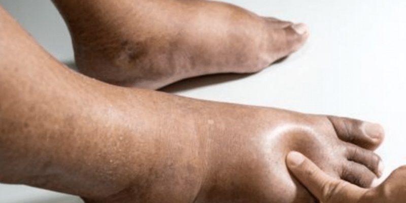 linfedema__Easy-Resize.com