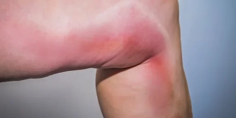 tromboflebite